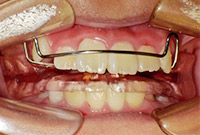 歯列矯正用咬合誘導装置バイオネーター