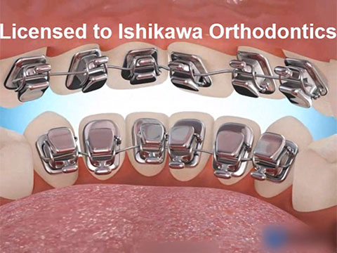 リンガルブラケット説明動画