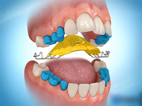 上顎拡大装置（可轍式）説明動画